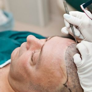 Which is the Best Hair Transplant Technique/Methods?