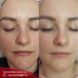 Glutathione injection