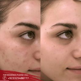 Glutathione injection cost in Islamabad