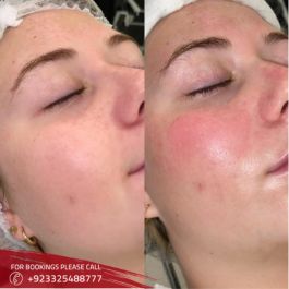 Glutathione injection in Islamabad