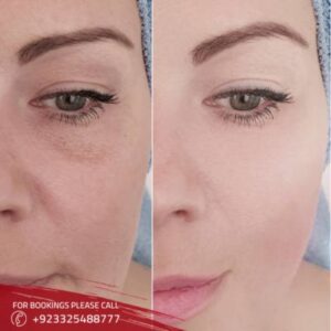 before after of Glutathione in islamabad