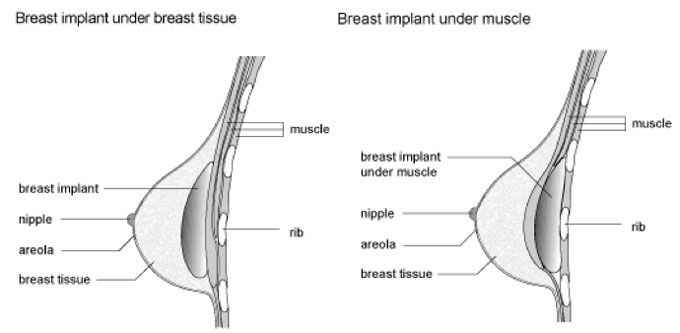 Breast Augmentation in Islamabad & Rawalpindi