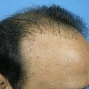 Advantages of Follicular Unit Extraction
