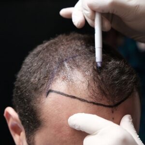 What’s the Ideal Age For Hair Transplant Surgery?