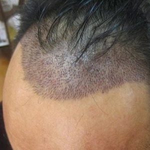 Use of Mini and Micro Grafts in Hair Transplant Islamabad