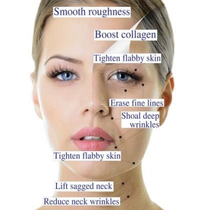 Fine lines & Wrinkles Removal in Islamabad, Rawalpindi - Cost, Price