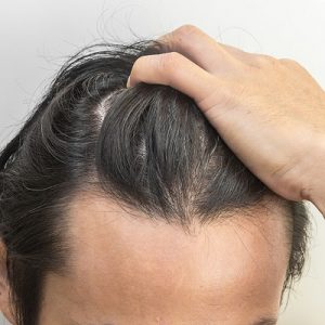 Frequently Asked Questions About Hair Transplant Surgery
