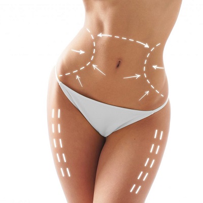 Liposuction Best Method to Get Rid Of Belly Fat in Islamabad