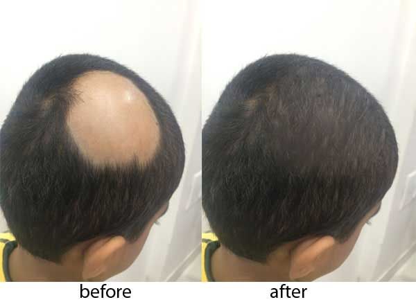 alopecia areata universalis treatment alopecia areata universalis treatment