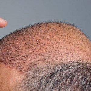 Comparison of Different Treatments of Hair Transplant