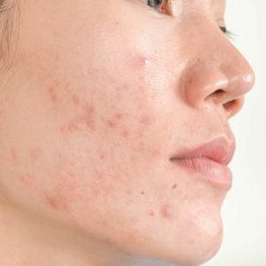 Acne Scar Treatment Cost Islamabad