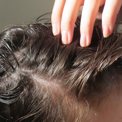 Major Causes and Treatment of Hair Loss