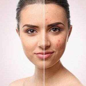 10 Unknown Myths about Acne Scars