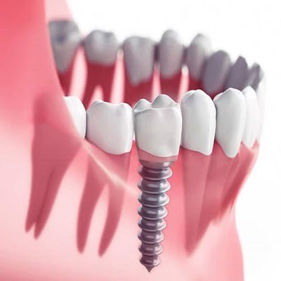 Dental Implants Cost in Islamabad, Pakistan