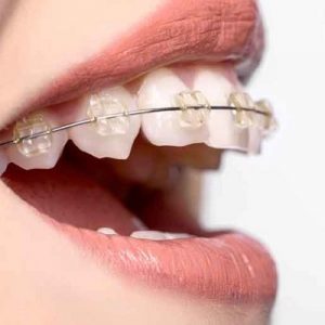 How Much is Teeth Scaling Cost in Islamabad?