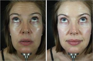 8 Point Facelift with Juvederm in Islamabad