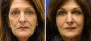 8 Point Facelift with Juvederm in Islamabad pakistan