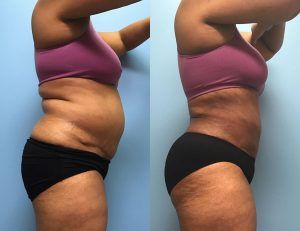 Best Liposuction in Islamabad & Rawalpindi