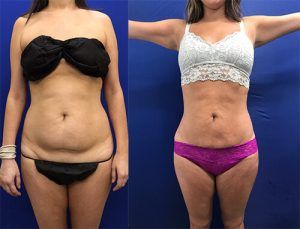 Best Liposuction in Islamabad & Rawalpindi, Pakistan