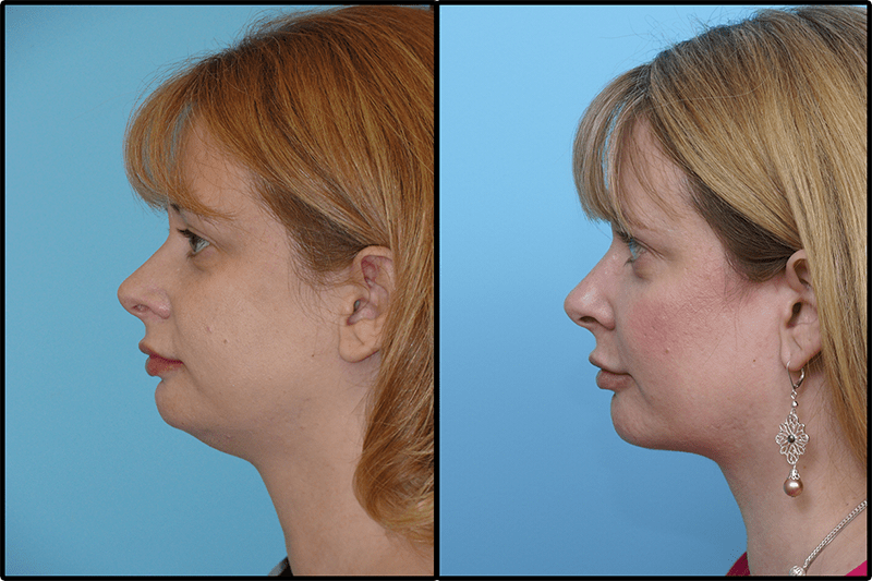 Double Chin Removal in Islamabad, Rawalpindi & Pakistan Cost, Price