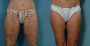 Thigh Lift in Rawalpindi