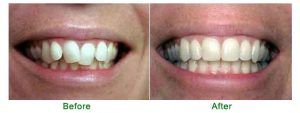 Dental Braces - Teeth Braces in Islamabad, Rawalpindi