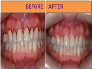 Gum Bleeding Treatment in Islamabad