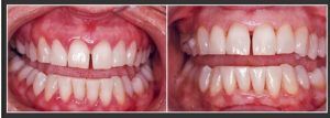 Gum Bleeding Treatment in Islamabad, Rawalpindi