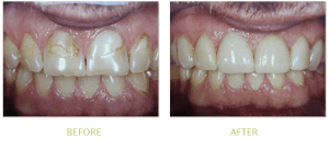 Root Canal Treatment in Islamabad, Lahore