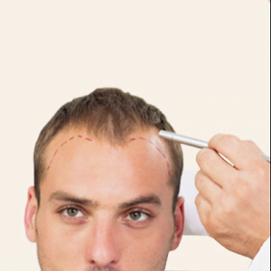 Benefits and side effects of Hair Transplant
