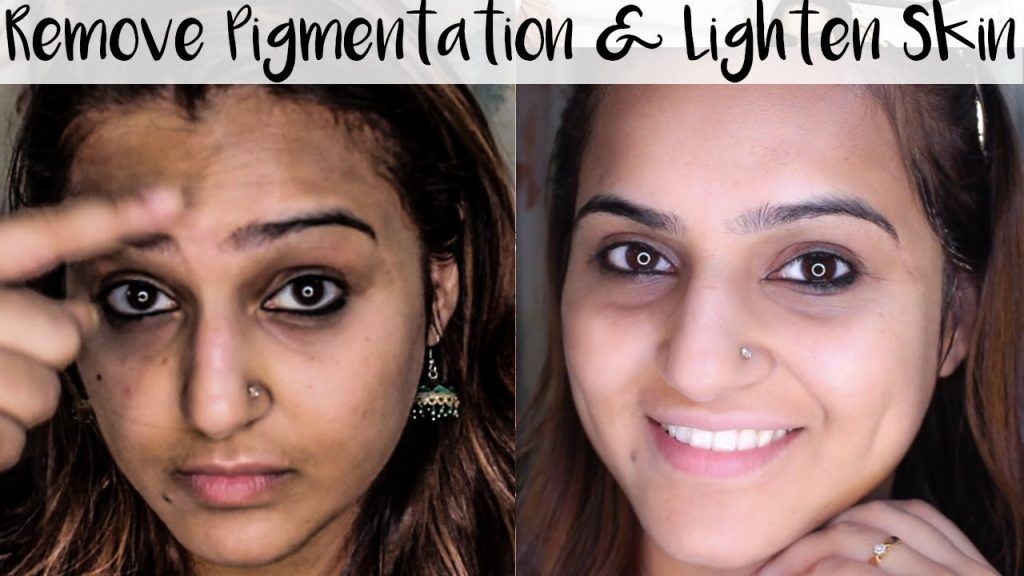 Laser Treatment In Islamabad Rawalpindi Pakistan SKN Clinic