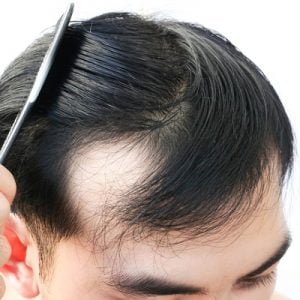 Side effects of FUE Hair Transplant