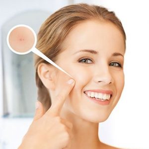 Acne Scars Treatment Options