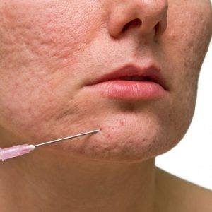 Can Acne Scars be Removed Non-Surgically?