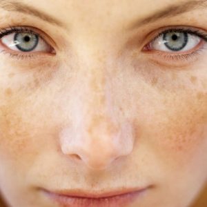Facial Pigmentation Treatment – Most Important Thing to Know