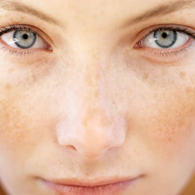 Facial Pigmentation Treatment - Most Important Thing to Know