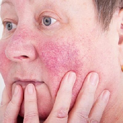 Rosacea treatment in Islamabad, Rawalpindi & Pakistan