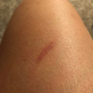How to get rid of post surgical scars?