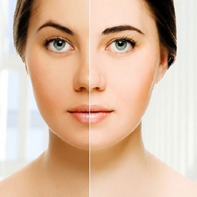 Is Skin Whitening treatment a confidence booster?