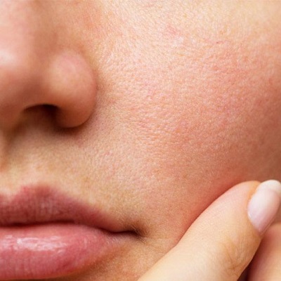 Large Pores – Treatments and Solutions