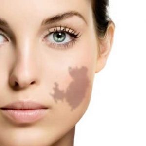 Laser The Safest way to get Rid of Birthmarks