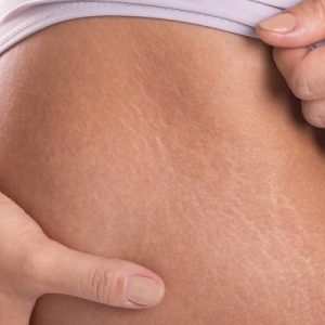Stretch Mark Causes – Is It Really Stretched Skin?