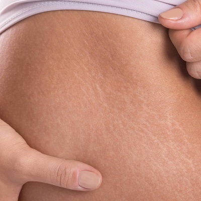 Stretch Mark Causes – Is It Really Stretched Skin