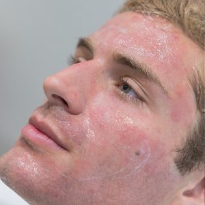 Why is Dermapen in Islamabad an ideal option