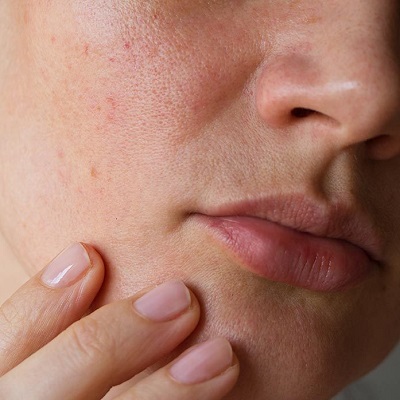Large Pores Treatments and Solutions