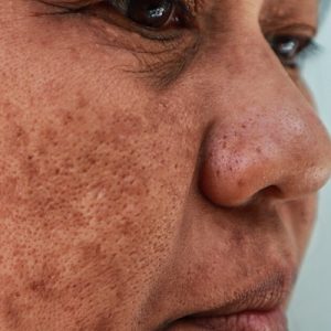 Melasma Treatment for Dark Skin