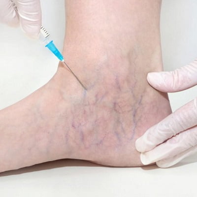 Spider Vein Treatment through Laser