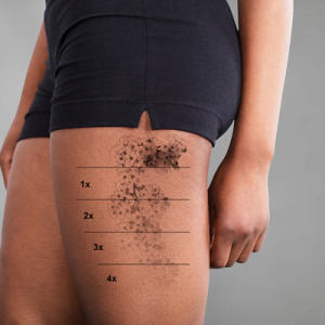 Why is laser tattoo removal the best option ?