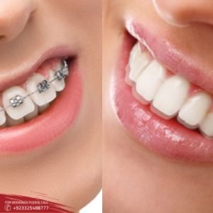 Invisible Braces before and after