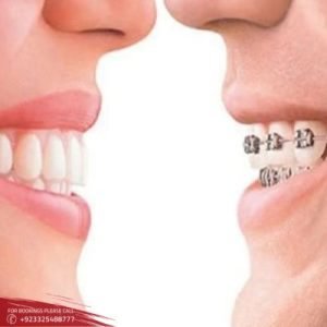 Invisible Braces cost in Islamabad